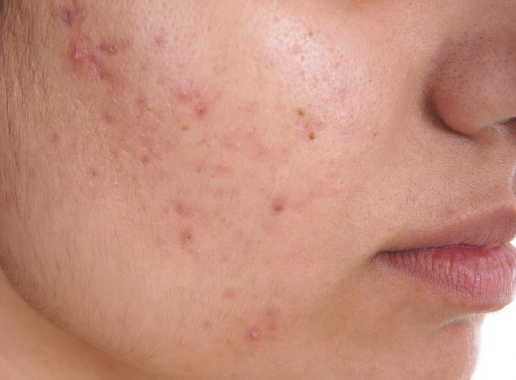 Mụn trứng cá dai dẳng trên mặt (Ảnh: Sưu tầm)