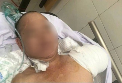 Bệnh nhân được phẫu thuật lần 1