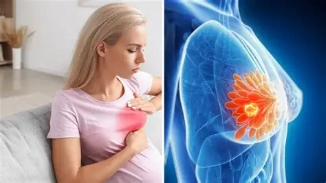 Tắc tia sữa khiến bầu vú xuất hiện khối cứng, đau, nếu không xử lý sớm có thể dẫn đến viêm vú. (Ảnh: Sưu tầm)