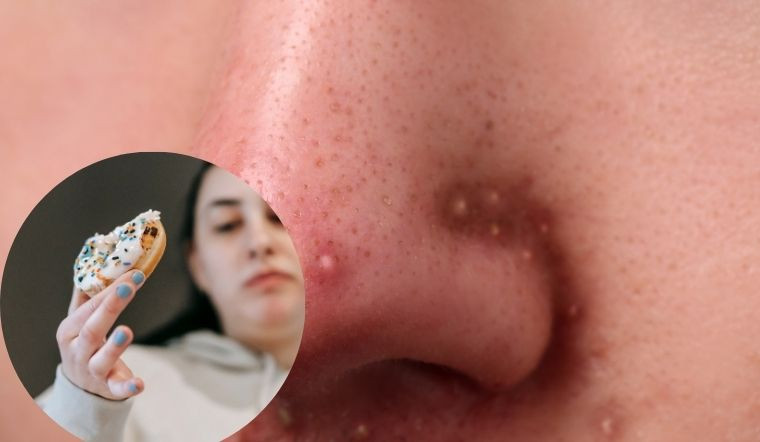 Ăn nhiều đồ chiên rán, bánh mứt ngày Tết dễ khiến làn da tiết dầu nhiều hơn và bùng phát mụn nếu không kiểm soát hợp lý. (Ảnh: Sưu tầm)