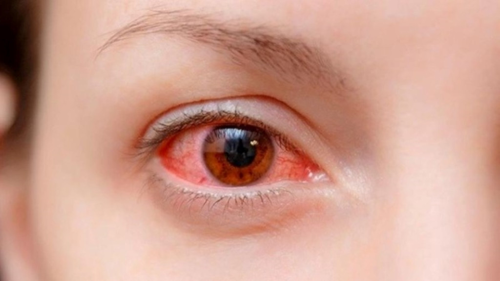 Mắt đỏ có thể là biểu hiện của nhiễm trùng nặng (Ảnh: Sưu tầm)