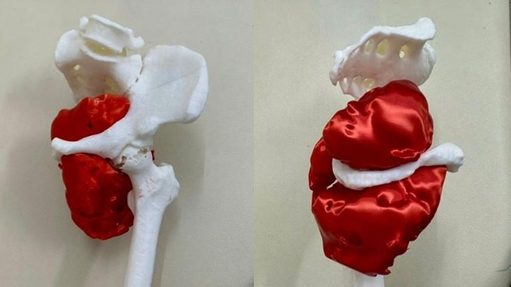 Dựng hình 3D khung chậu trước khi phẫu thuật (Ảnh: BVCC)