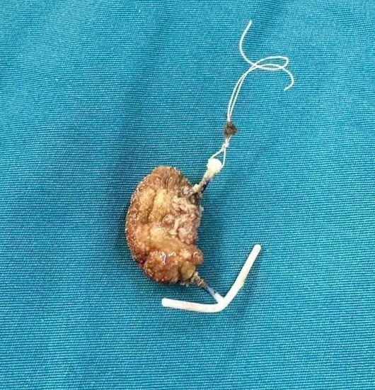 Dị vật được cho là vòng tránh thai đặt cách đây 22 năm đã 