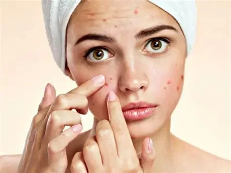 Nóng trong người khiến cơ thể bứt rứt, da dễ nổi mụn và ảnh hưởng đến giấc ngủ. (Ảnh: Sưu tầm)