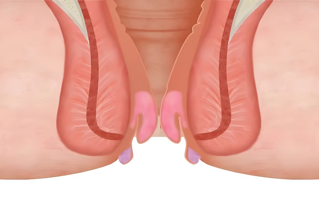 Triệu chứng bệnh trĩ ban đầu thường khó nhận biết (Ảnh: Sưu tầm)