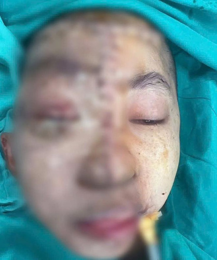 Hình ảnh trước phẫu thuật (ảnh trái) và sau phẫu thuật (Ảnh: BVCC)