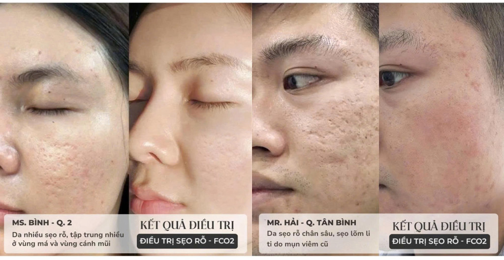 Tình trạng sẹo rỗ của khách hàng cải thiện rõ rệt sau liệu trình điều trị tại Phòng khám Da liễu LG