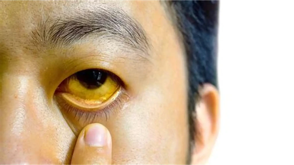 Vàng da, vàng mắt là dấu hiệu cảnh báo men gan cao không nên bỏ qua. (Ảnh: Sưu tầm)