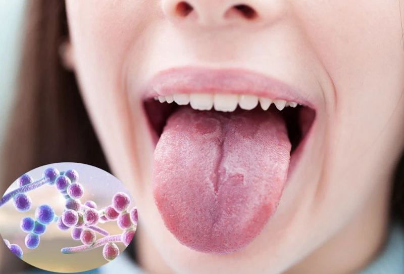 Nhiễm nấm Candida có thể xảy ra ở nhiều vị trí trên cơ thể. (Ảnh: Sưu tầm)