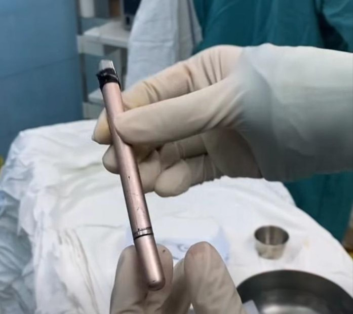 Dị vật là cây bút được bác sĩ lấy ra khỏi bàng quang của bệnh nhân (Ảnh: BVCC)