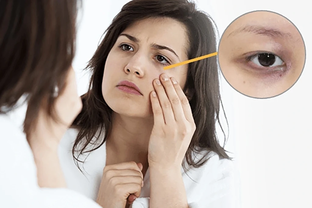Xác định đúng nguyên nhân và chăm sóc đúng cách giúp cải thiện quầng thâm mắt hiệu quả tại nhà. (Ảnh: Sưu tầm)