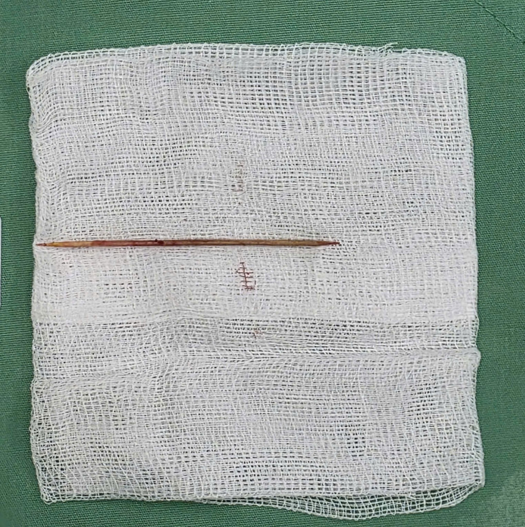 Dị vật được lấy ra là một que tăm nhọn (Ảnh: BVCC)