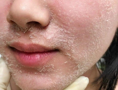 Peel da giúp cải thiện nhiều vấn đề về da, nhưng nếu thực hiện tại nhà không đúng cách có thể gây tổn thương da nghiêm trọng. (Ảnh: Sưu tầm)