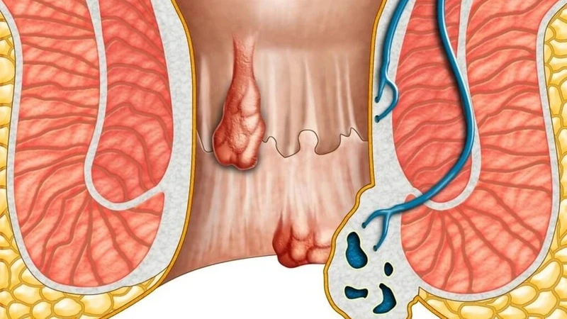 Ung thư hậu môn chiếm tỷ lệ cao nhất (Ảnh: Sưu tầm)