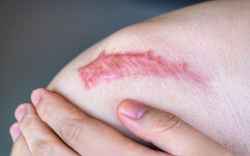Trước khi áp dụng mẹo dân gian trị sẹo lồi, nên thử trên vùng da nhỏ để tránh kích ứng. (Ảnh: Sưu tầm)