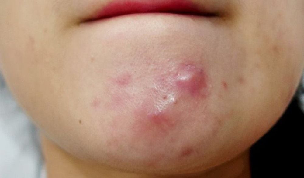 Không nên tự ý nặn mụn bọc (Ảnh: Sưu tầm)
