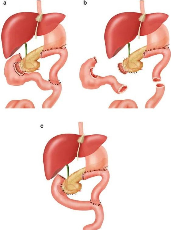 Minh họa kỹ thuật tái tạo đường tiêu hóa sau khi cắt bỏ tá tràng (Ảnh: ScienceDirect)