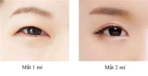 Bấm mí phù hợp với người trẻ, mí chưa chùng và ít mỡ thừa, thời gian thực hiện nhanh, ít sưng nề. (Ảnh: Sưu tầm)