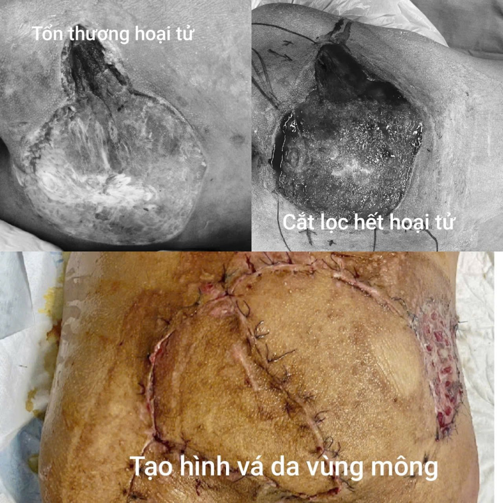 ạo hình vá da vùng mông thành công cho người bệnh (Ảnh: BVCC)