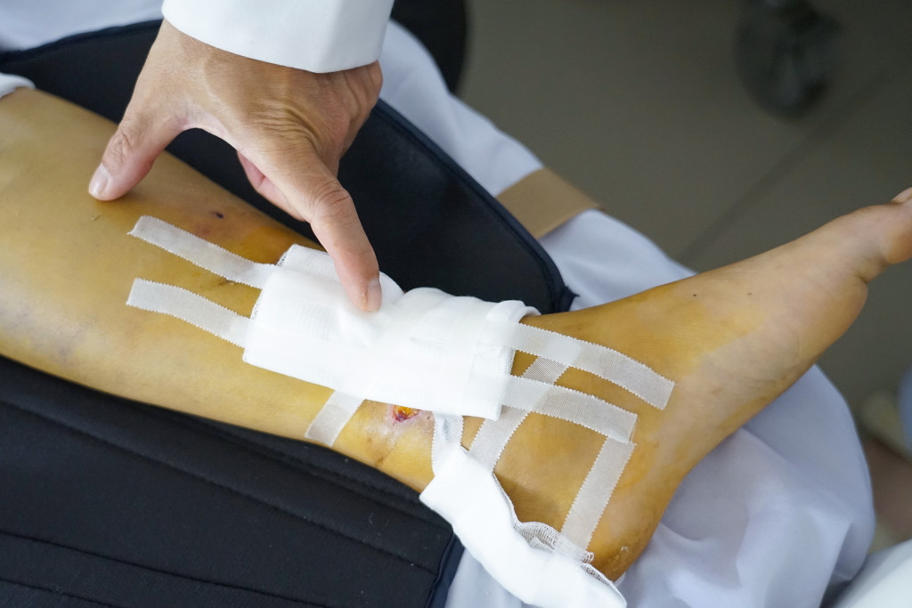 Tổn thương vùng cẳng chân trái của bệnh nhân được xử trí và cố định trong quá trình điều trị (Ảnh: BVCC)