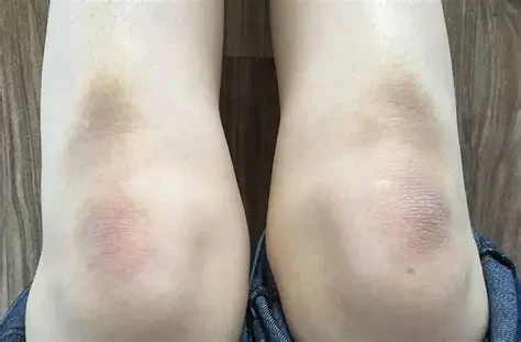 Thói quen ma sát thường xuyên và chăm sóc da chưa đúng cách có thể khiến vùng da đầu gối trở nên sạm màu, khô ráp. (Ảnh: Sưu tầm)