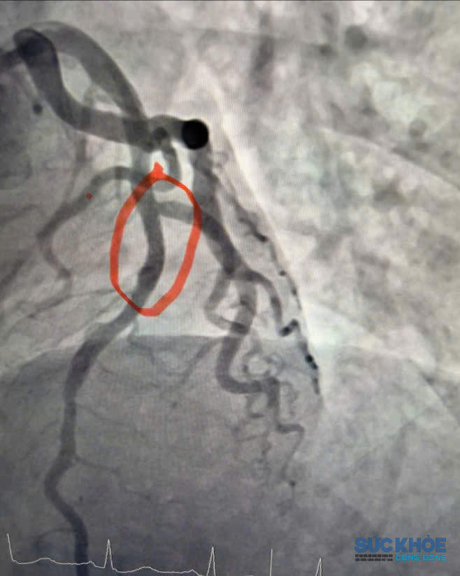 Hình ảnh động mạch vành sau can thiệp đặt stent, dòng máu nuôi cơ tim được tái thông tốt (ảnh: TL)