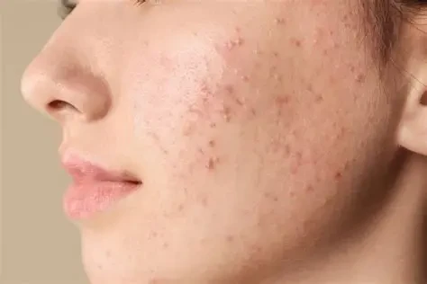 Người có làn da dễ bị mụn nên cân nhắc giảm lượng sữa bò và thay thế bằng các loại sữa hạt trong chế độ ăn. (Ảnh: Sưu tầm)