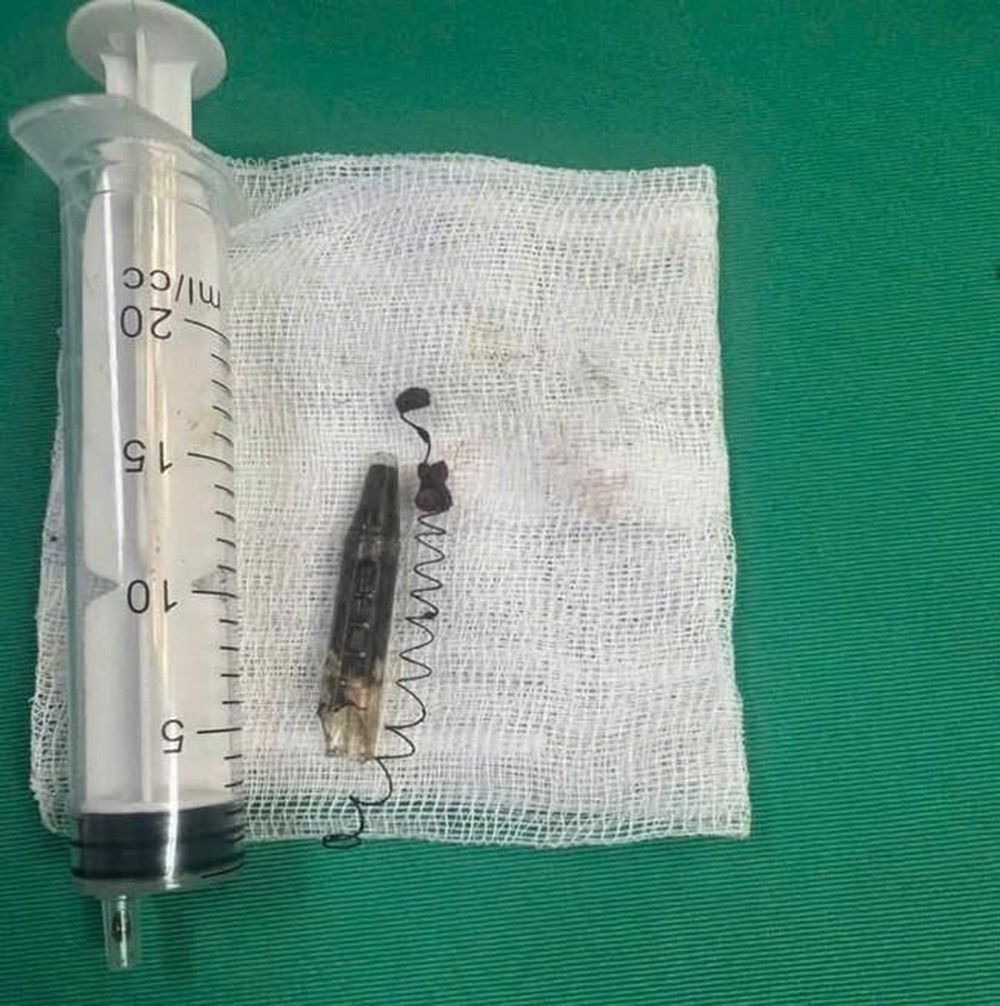 Dị vật sau 13 năm được gắp ra, giải thoát tình trạng đau đầu cho bệnh nhân (Ảnh: BVCC)