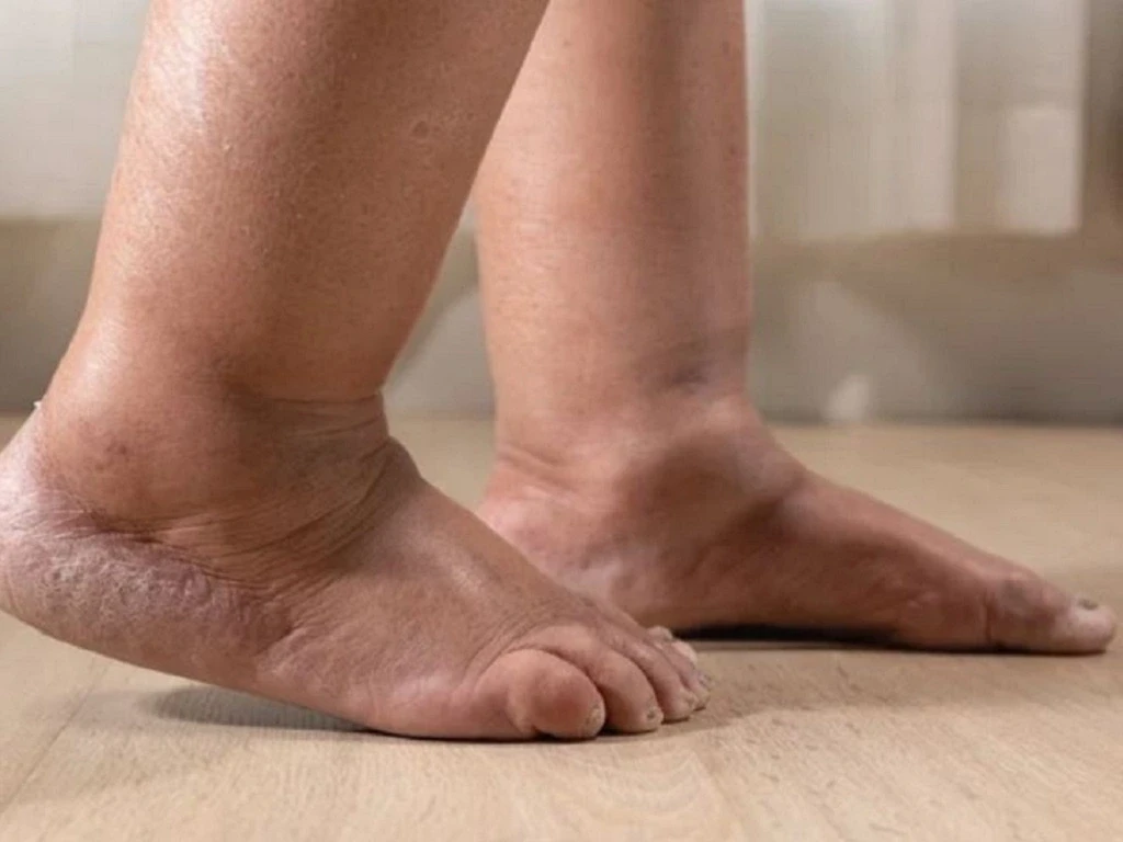 Sưng phù chân là dấu hiệu của rối loạn hệ bạch huyết (Ảnh: Sưu tầm)