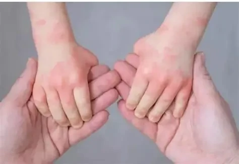 Giữ ẩm và vệ sinh đúng cách giúp giảm triệu chứng viêm da cơ địa. (Ảnh: Sưu tầm)