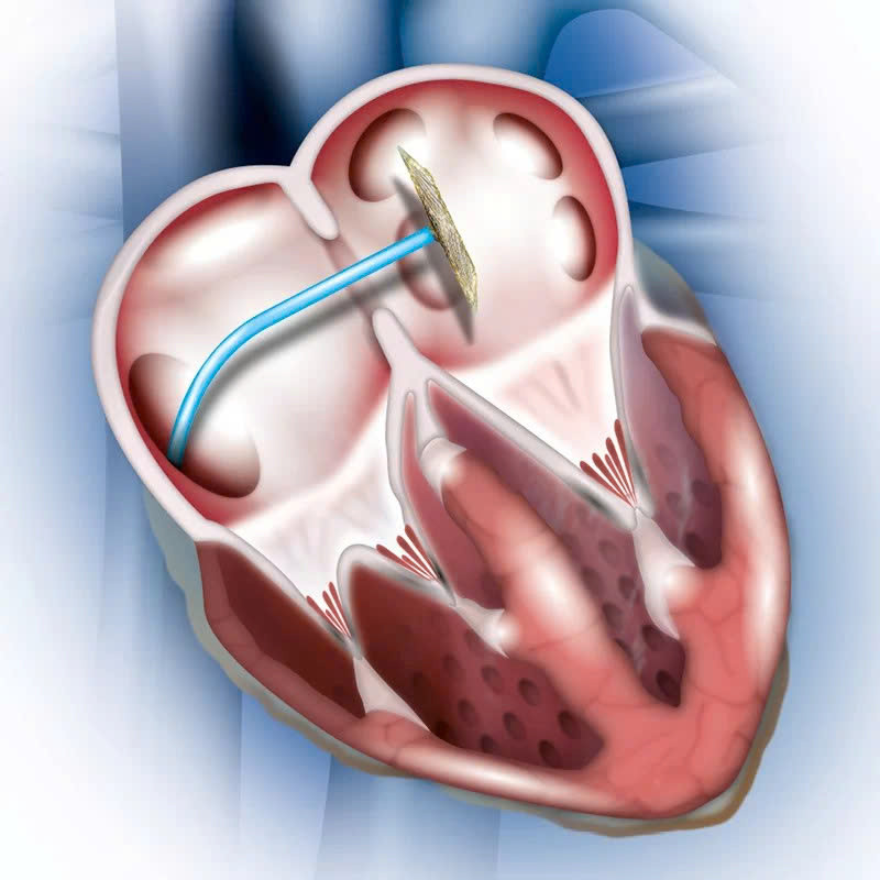 Thông liên nhĩ là một trong những dị tật tim bẩm sinh phổ biến, trong đó tồn tại lỗ thông bất thường giữa hai buồng nhĩ của tim (Ảnh: TL)