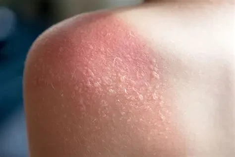Da cháy nắng thường đỏ rát và dễ bong tróc nếu không chăm sóc đúng cách. (Ảnh: Sưu tầm)