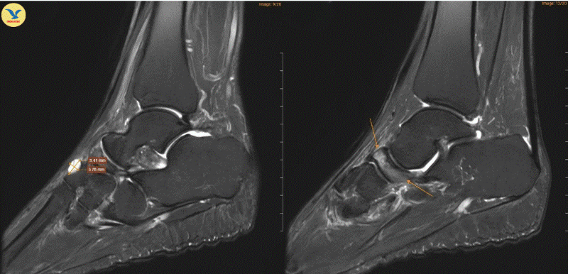Hình ảnh chụp MRI cho thấy những dấu hiệu đặc trưng của Hội chứng Mueller-Weiss ở chân phải