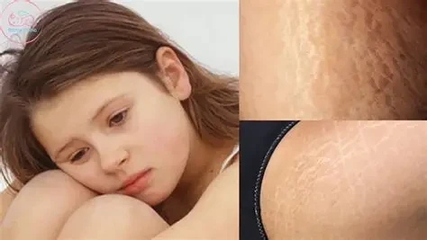 Rạn da tuổi dậy thì thường xuất hiện khi cơ thể phát triển nhanh về chiều cao và cân nặng (Ảnh: Sưu tầm)