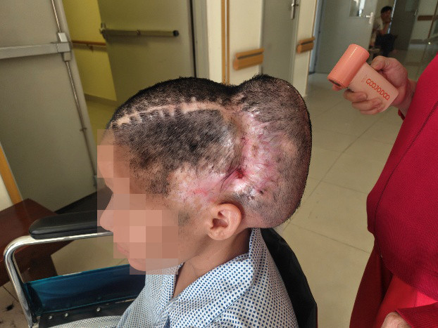 Bệnh nhân được phẫu thuật đặt túi giãn da tại vùng thái dương - chẩm có tóc (Ảnh: BVCC)