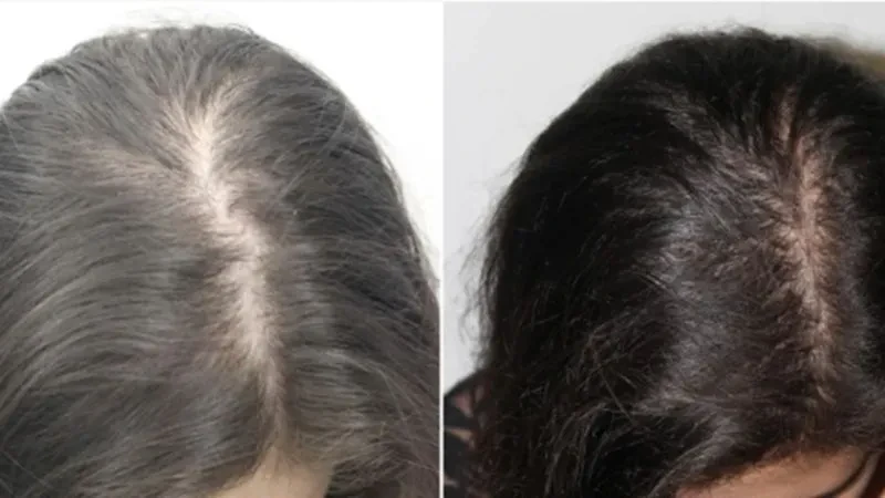 Ủ tóc với vitamin B1 là mẹo đơn giản giúp nuôi dưỡng tóc chắc khỏe và hỗ trợ giảm gãy rụng. (Ảnh: Sưu tầm)