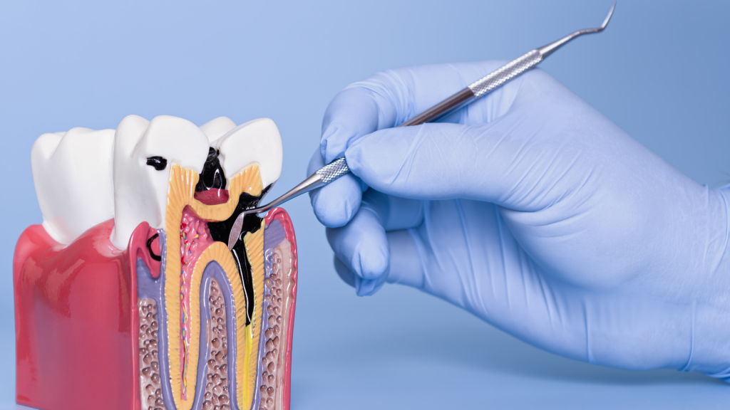Nhổ khi răng có những vấn đề không thể phục hồi (Ảnh: Sưu tầm)