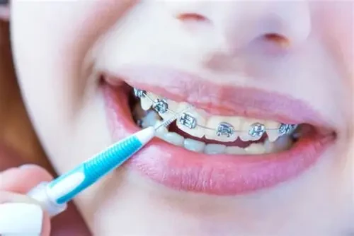 Sử dụng bàn chải kẽ và chỉ nha khoa giúp làm sạch sâu quanh mắc cài, bảo vệ nướu khỏe mạnh (Ảnh: Sưu tầm)