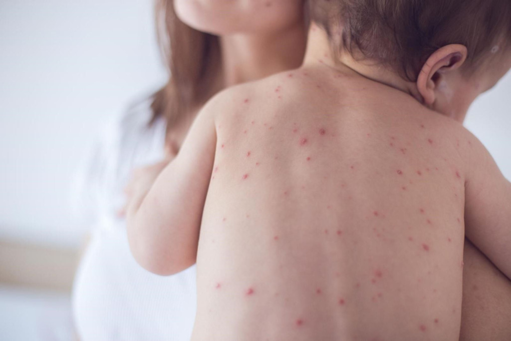 Bị thủy đậu từ sớm vẫn có nguy cơ tái nhiễm (Ảnh: Sưu tầm)