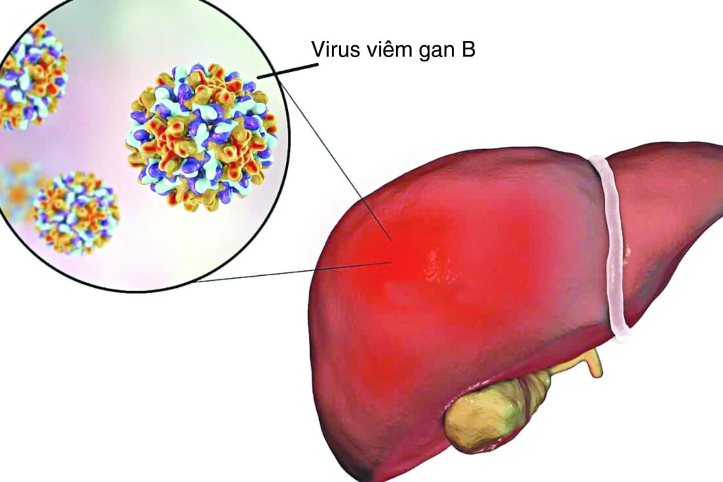Viêm gan B (Ảnh: Sưu tầm)