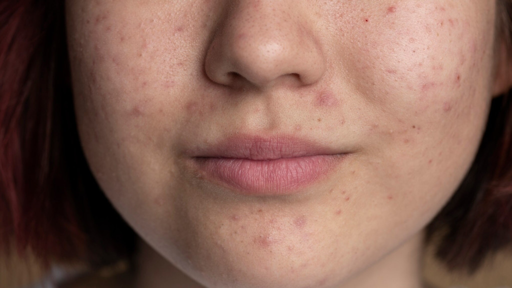Da nhiễm corticoid cần thời gian phục hồi (Ảnh: Sưu tầm)