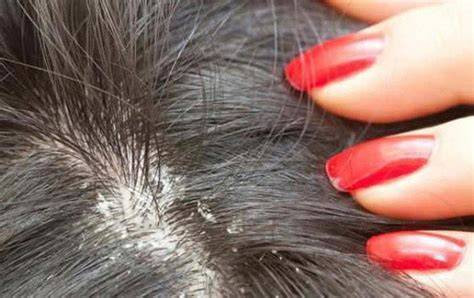 Giữ da đầu sạch và khô thoáng là bước quan trọng trong hỗ trợ điều trị nấm da đầu (Ảnh: Sưu tầm)