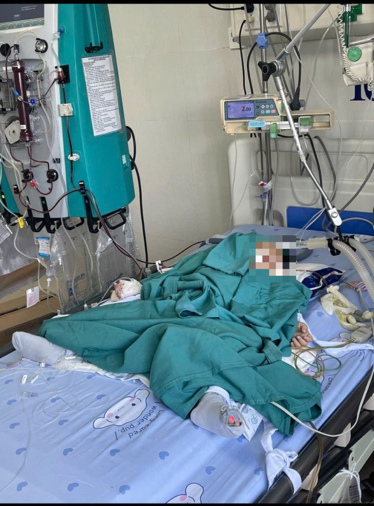 Trẻ phải lọc máu liên tục do nuốt phải tinh thể đồng sunfat từ đồ thí nghiệm anh trai mang về nhà (Ảnh: BVCC)