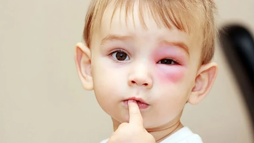Biểu hiện rõ rệt khi trẻ bị đau mắt đỏ (Ảnh: Sưu tầm)