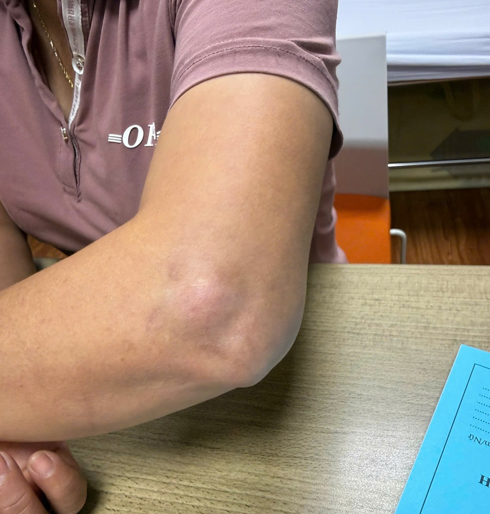 Hình ảnh tay bệnh nhân sau tiêm: Tình trạng đau không cải thiện, vùng tiêm xuất hiện teo tổ chức dưới da.(Ảnh: BVCC)