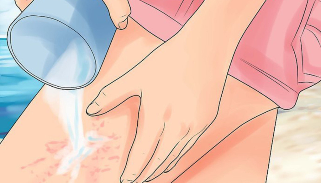 Nên rửa vết đốt bằng giấm nhằm hạn chế nọc độc (Ảnh: Sưu tầm)