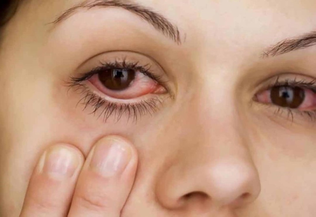 Chú ý tình trạng ghèn loãng kèm đau mắt đỏ (Ảnh: Sưu tầm)