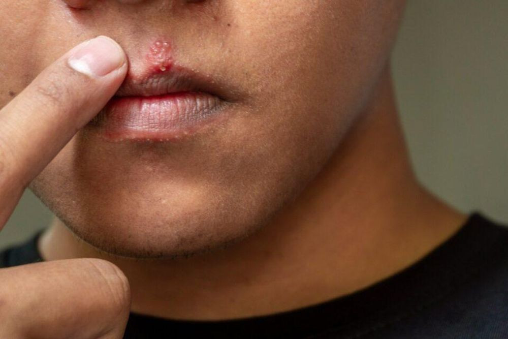Ung thư miệng giai đoạn đầu có thể gây ra các tổn thương lớn màu đỏ hoặc vết loét hở trong miệng (Ảnh: Healthline)