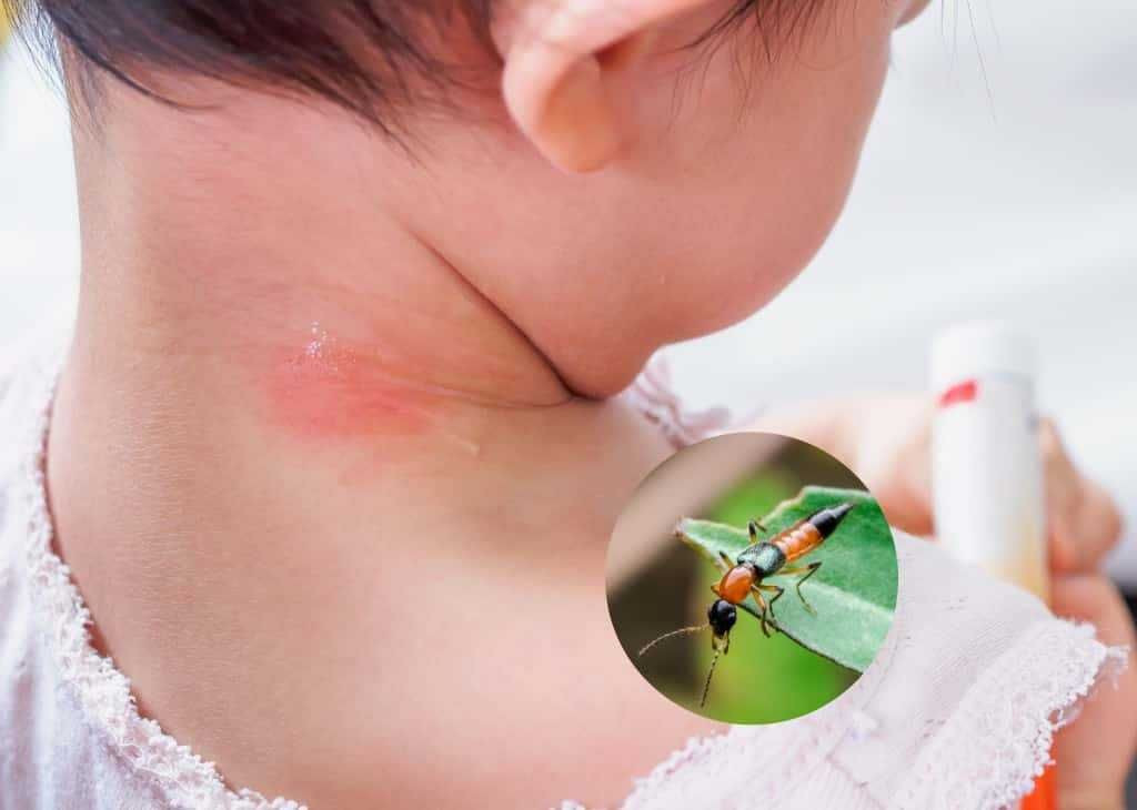 Da trẻ xuất hiện mụn mủ khi sau khi bị kiến ba khoang đốt (Ảnh: Sưu tầm)