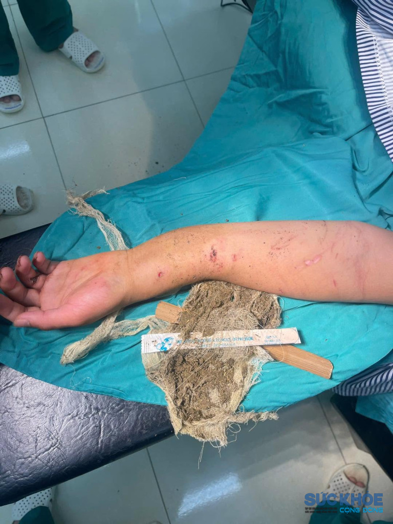 Cánh tay khi vừa nhập viện (ảnh: TL)